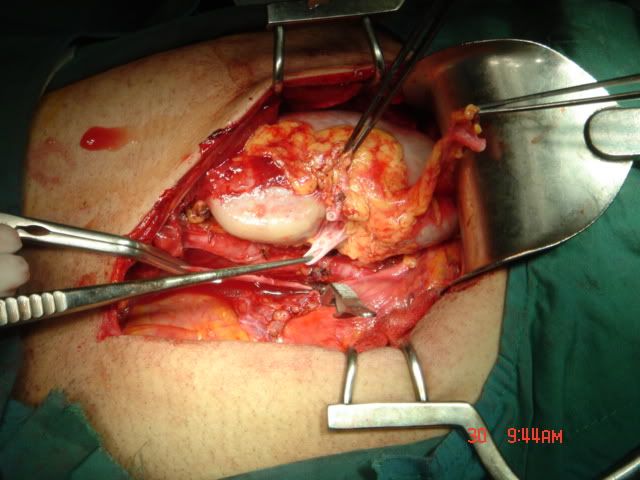 kidney surgery photo: Kidney Transplant in India kidneytransplant.jpg